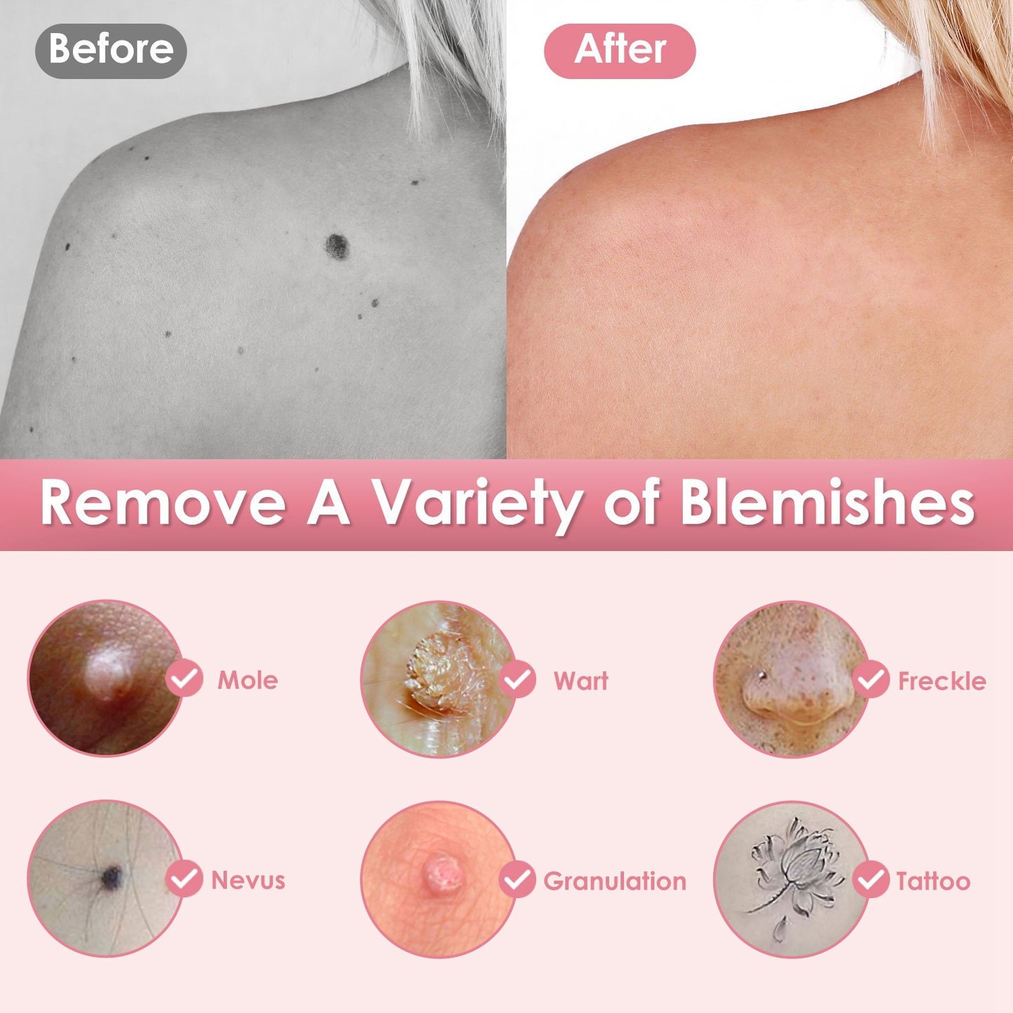 1Pc Skin Tag Remover Skin Tag Repair Kit Tattoo Freckle Wart Mole Remover Pen With 9 Intensity Levels 10 Fine Needles 3 Coarse Needles - DropOnline.co