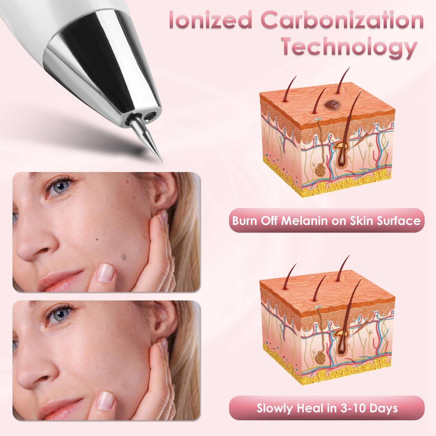 1Pc Skin Tag Remover Skin Tag Repair Kit Tattoo Freckle Wart Mole Remover Pen With 9 Intensity Levels 10 Fine Needles 3 Coarse Needles - DropOnline.co