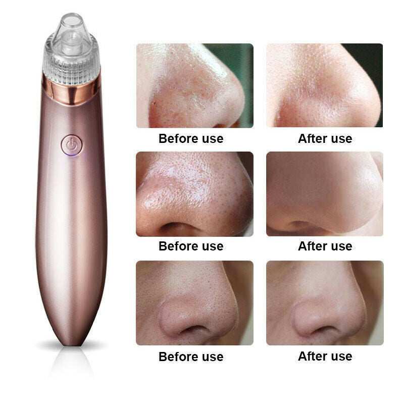 Electric Blackhead Vacuum Pore Cleaner Acne Pimple Remover Strong Suction Tool Electric Blackhead Remover Pore Vacuum Suction Diamond Dermabrasion Face Cleaner - DropOnline.co