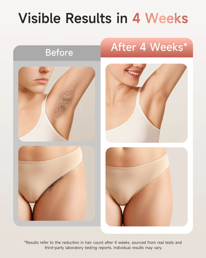 3-in-1 IPL Hair Removal Device, 999,900 Flashes
