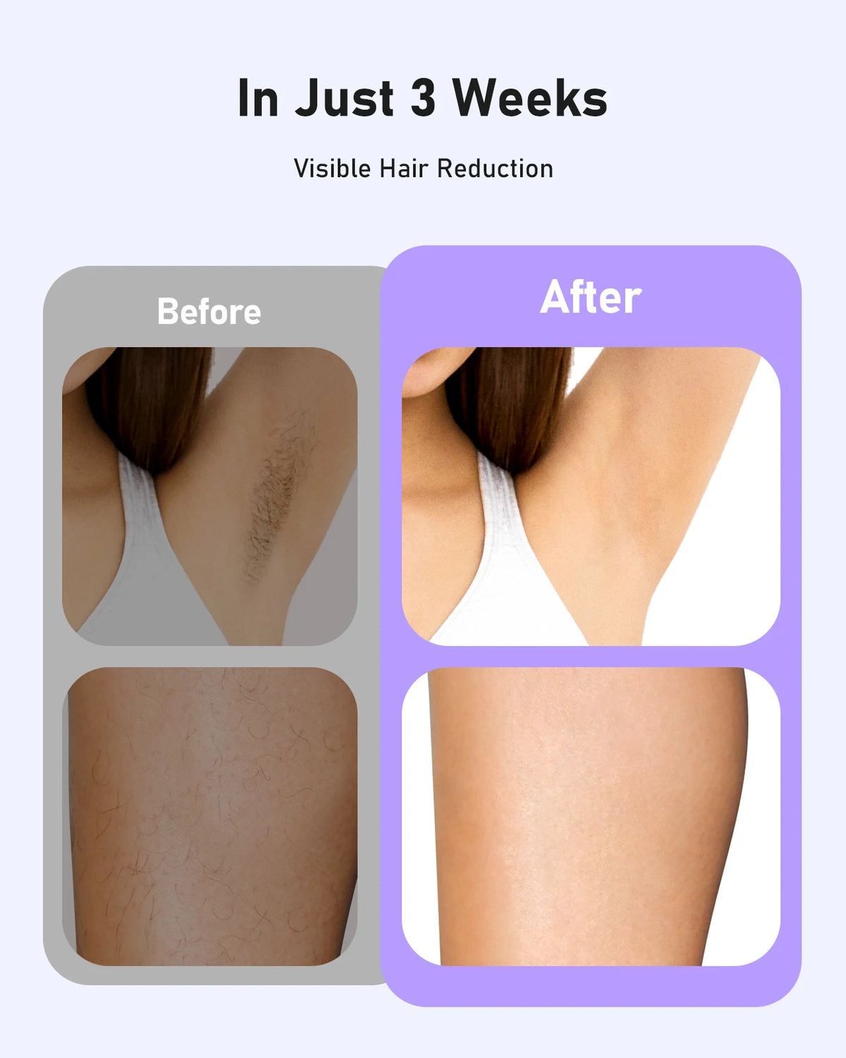 IPL Hair Reduction Device, 5.2cm² Window, 9 Levels